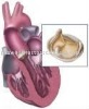 popular Enlarged heart model